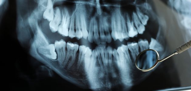 Dental x-ray Reflected in Dental Mirror on White Background