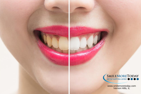 tips for teeth whitening at your home (2)