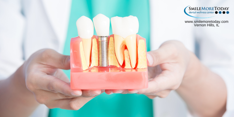 dental implants formissing teeth