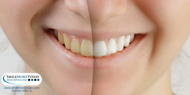 Achieve your cosmetic smile makeover with your Vernon Hills dentist (1)