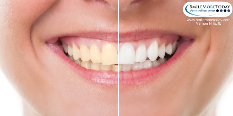Effective teeth whitening found in Vernon Hills