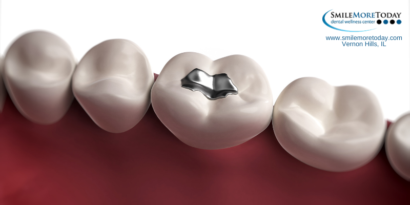 tooth color fillings in Vernon Hills