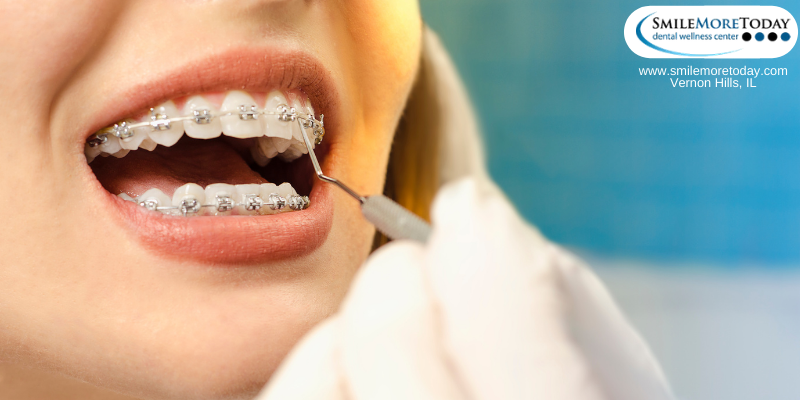 clear braces for teeth